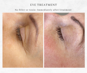 Westhoughton Mesotherapy Eye Treatment