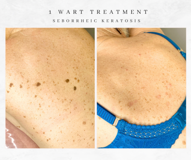 Westhoughton seborrheic keratosis wart treatment