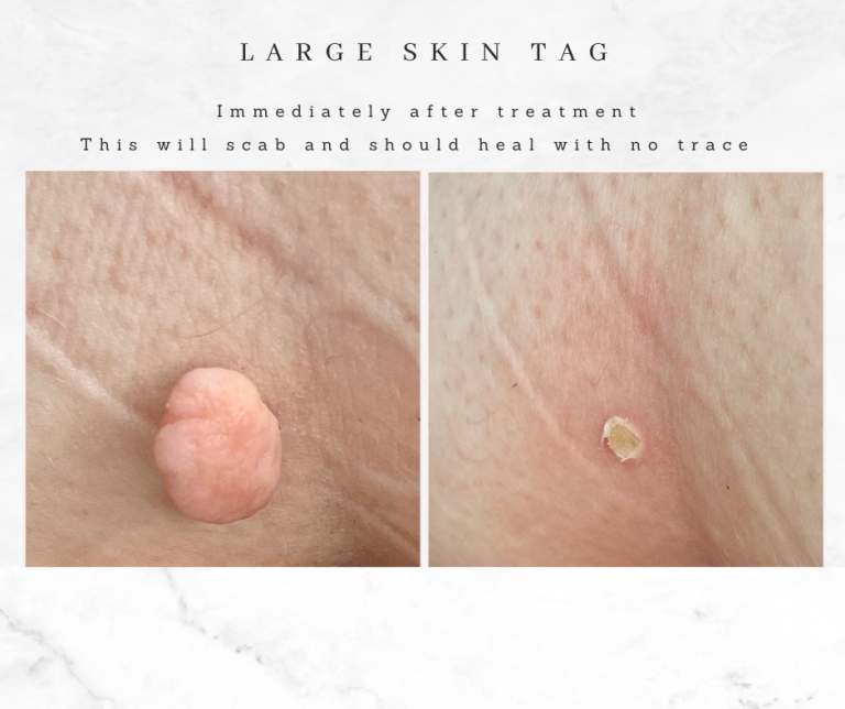 Large skin tag removal Bolton