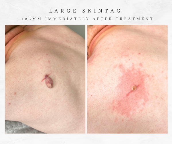 Westhoughton Skin Tag removal large skin tag