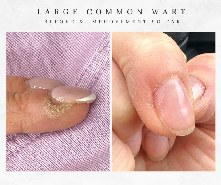 Westhoughton Wart Removal Treatment before and after common wart