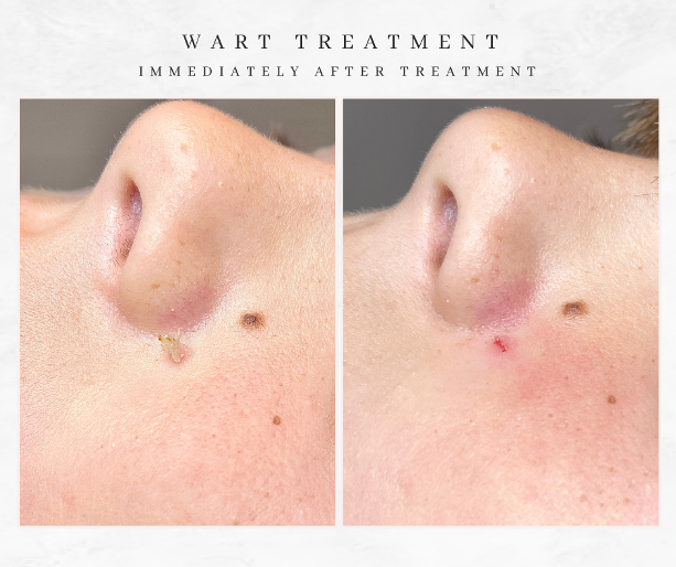 Westhoughton filiform wart removal