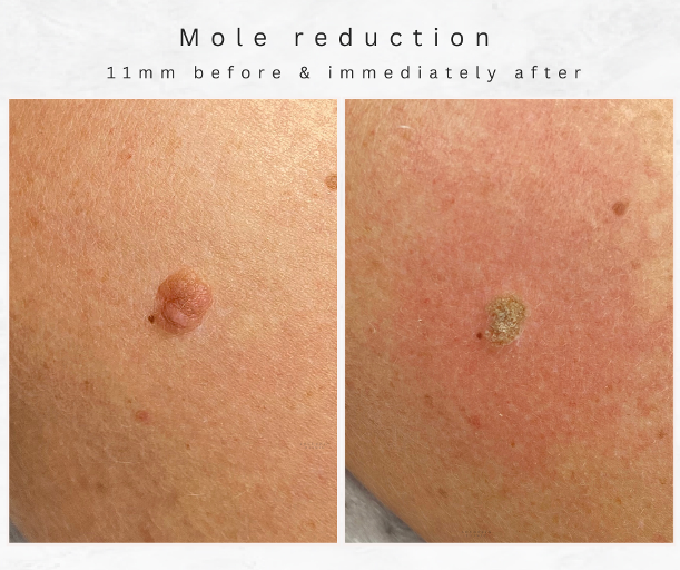 bolton Mole treatment Reduction