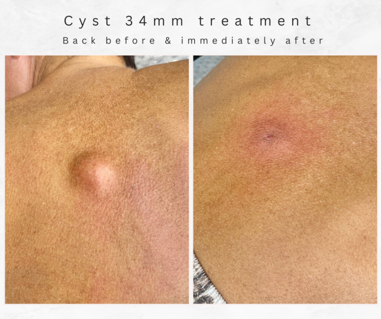 bolton cyst treatment skin