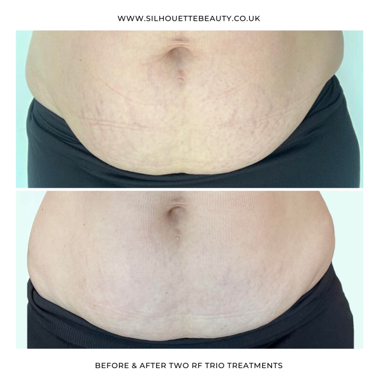 Westhoughton Radiofrequency treatment RF silhouette