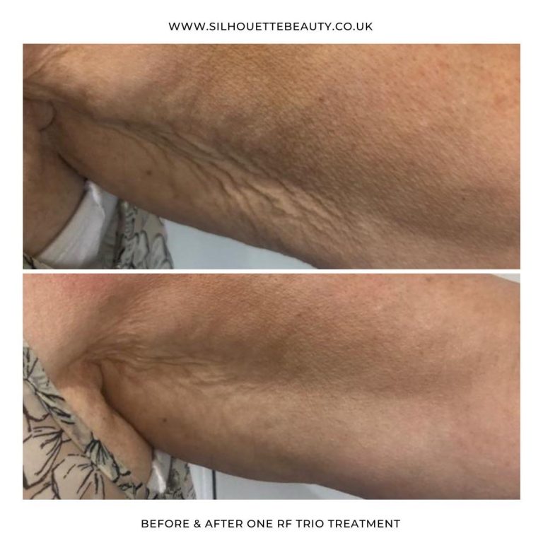 Arm tightening treatment bolton