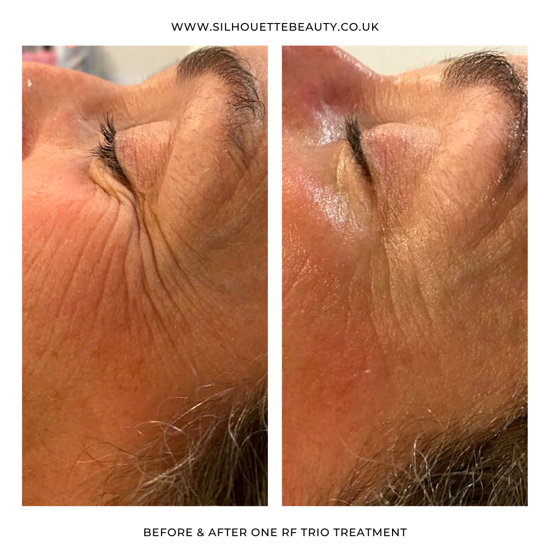 Eye concerns crows feet treatment westhoughton