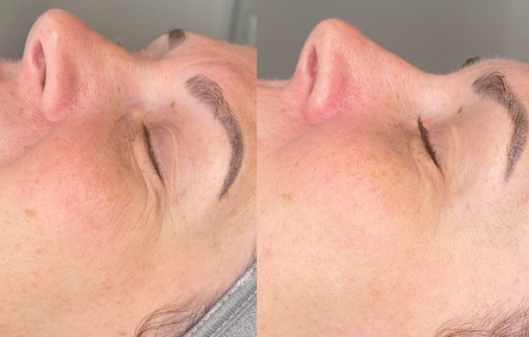 Microneedling facial treatment Bolton eye treatment