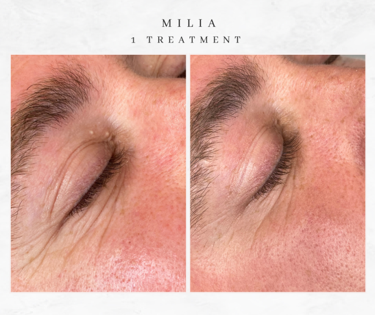 Westhoughton Milia treatment before and after