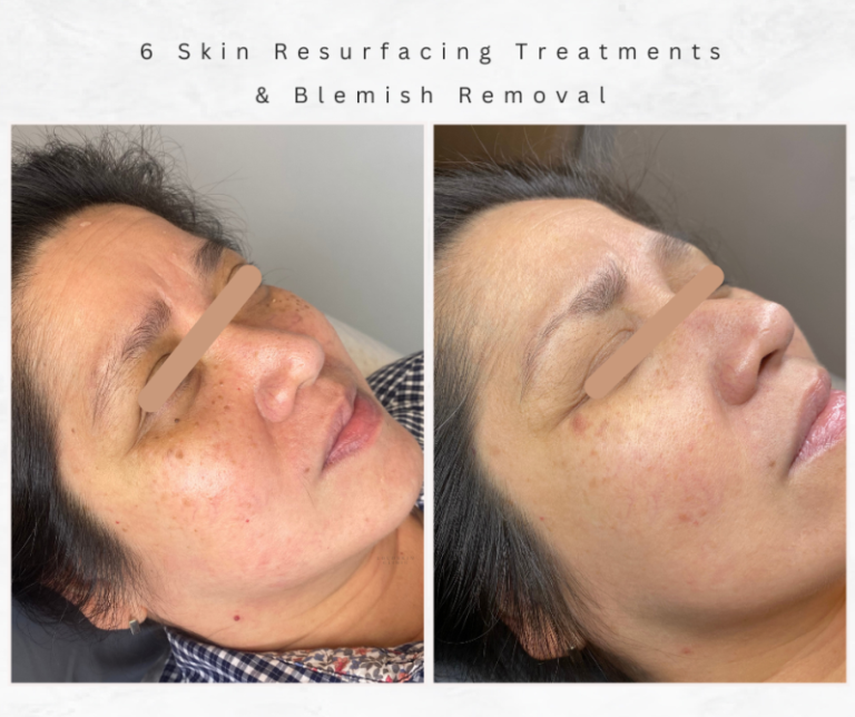 Westhoughton Skin Clinic Facials Resurfacing Treatment