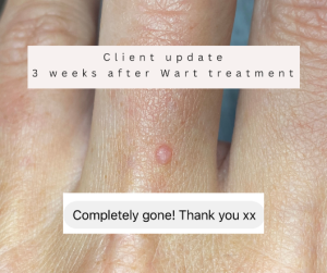 bolton Wart on finger treatment