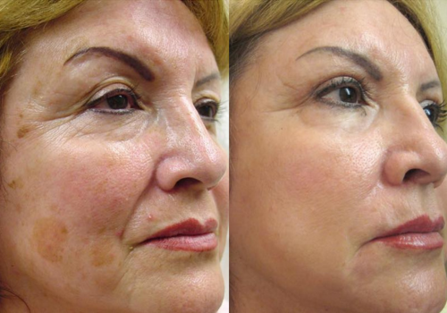 Loud Skin Clinic Westhoughton facial treatment