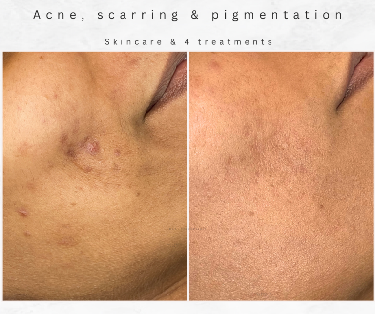 Bolton Acne treatment acne scarring westhoughton