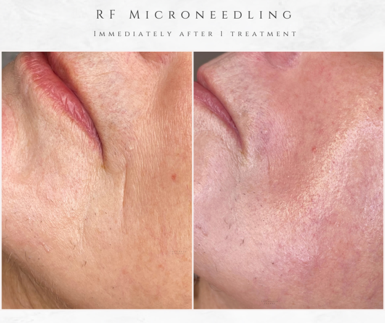 westhoughton rf microneedling lines