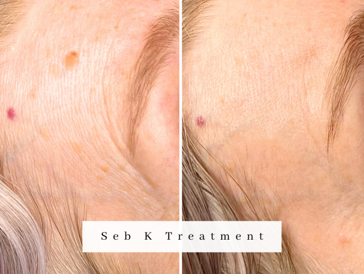 Sebhorreic keratosis treatment bolton seb k