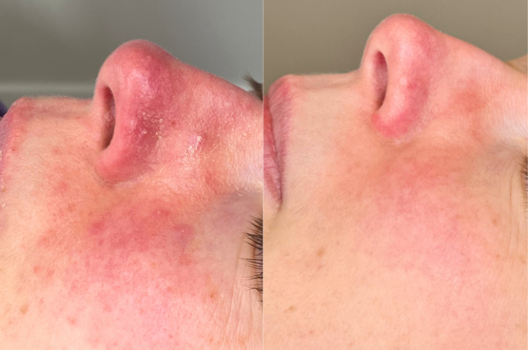 westhoughton Rosacea Before & after Skinc