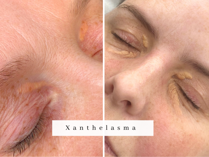 westhoughton Xanthelasma Treatment