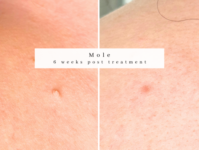 Advanced Electrolysis Mole treatment bolton manchester