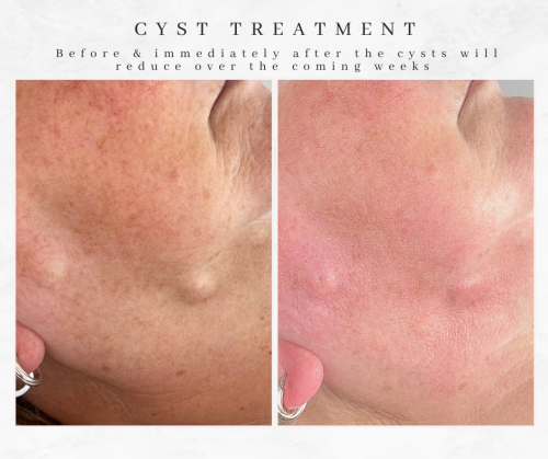 westhoughton cysts treatment face epidermoid cysts before and immediately after